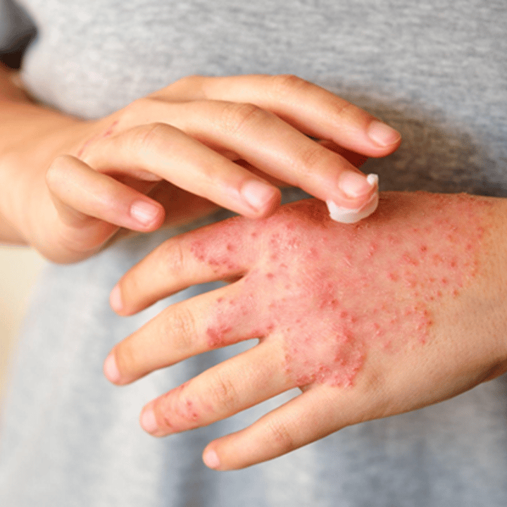 A man rubbing cream onto an eczema rash on the back of his hand