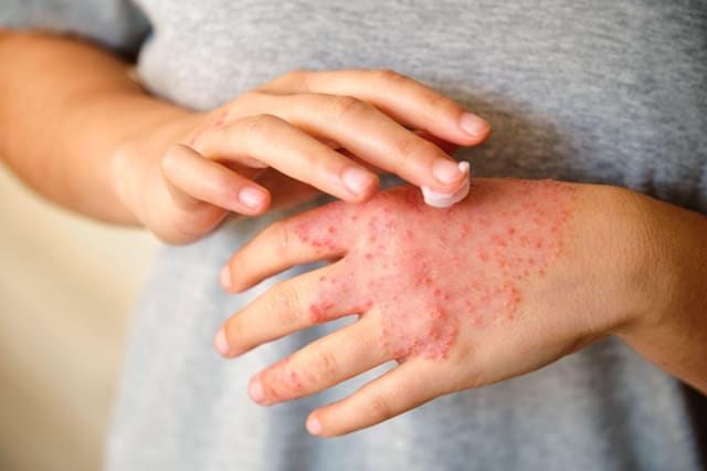 A man rubbing cream onto an eczema rash on the back of his hand